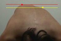 scoliosis20bending20test